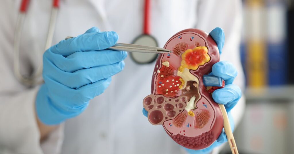 5 Stages of Chronic Kidney Disease